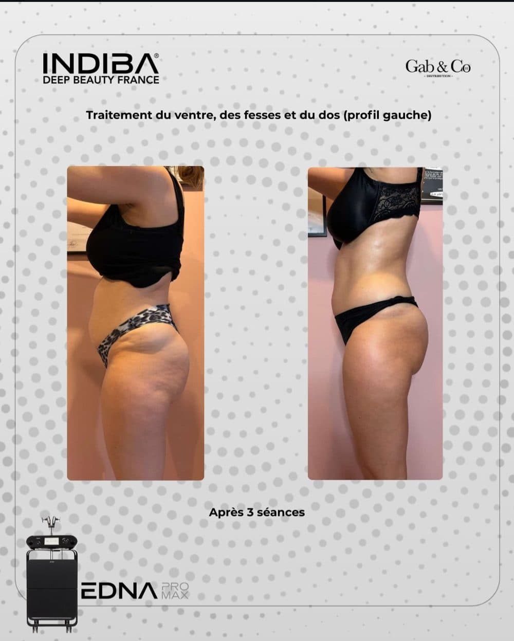 Avant / après traitement ventre, fesses et dos INDIBA